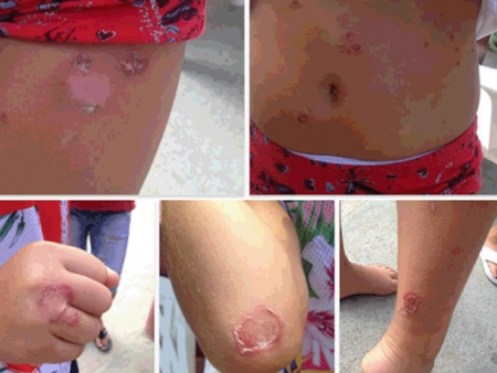 Decine di bambini con virulente infezioni batteriche alla cute: colpa dell&#039;inquinamento da spiaggia?
